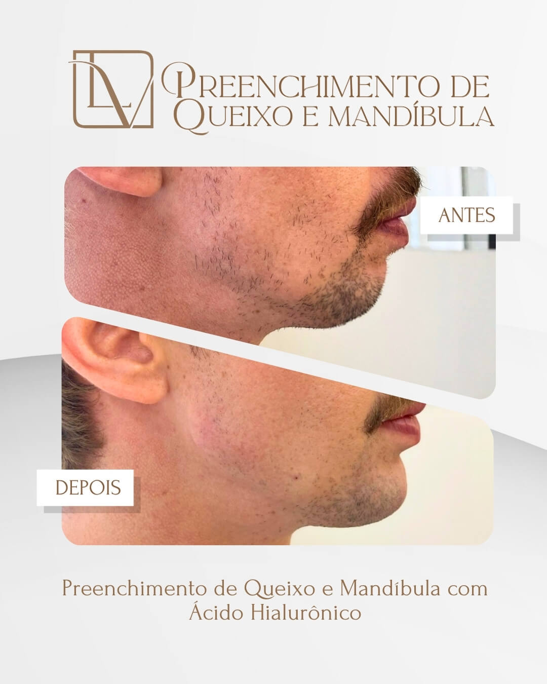 Resultado de preenchimento de queixo e mandíbula antes e depois
