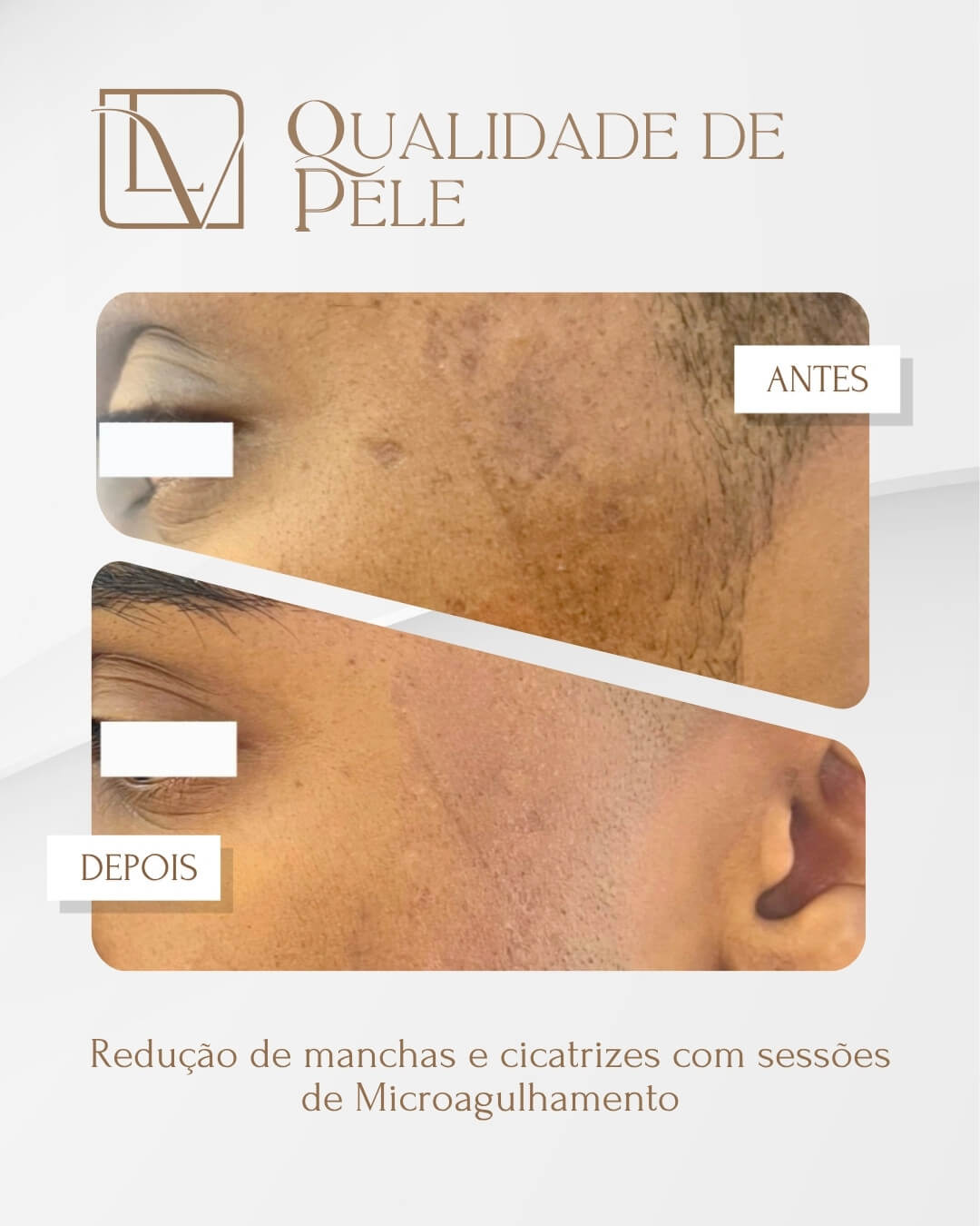 Resultado de melhora da qualidade da pele antes e depois
