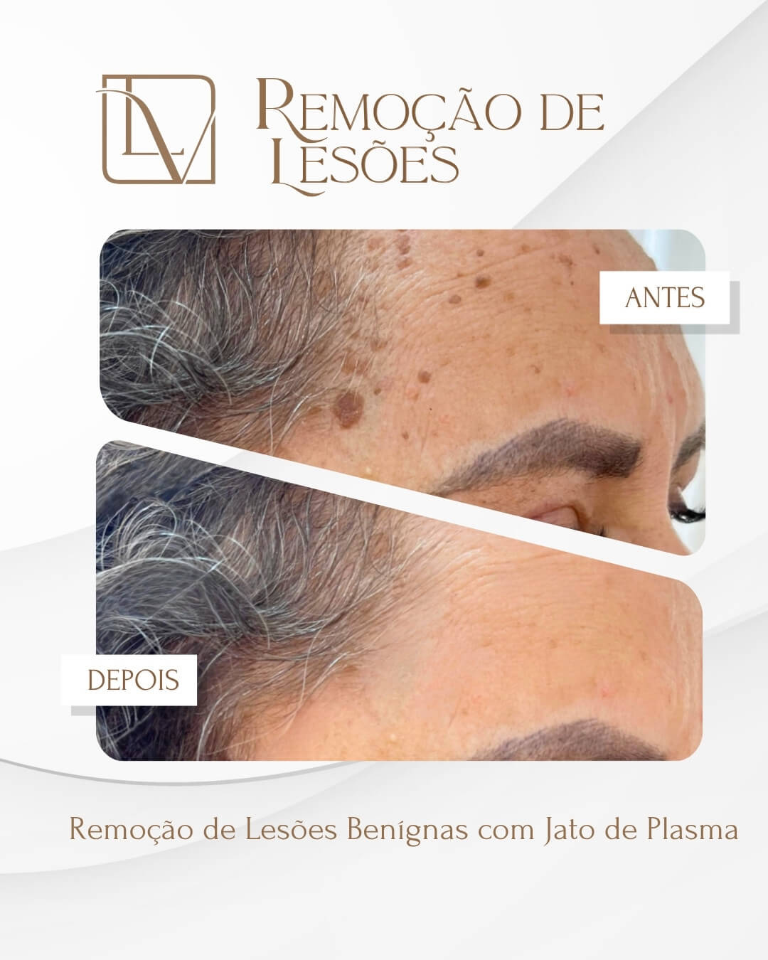 Resultado de remoção de lesões antes e depois