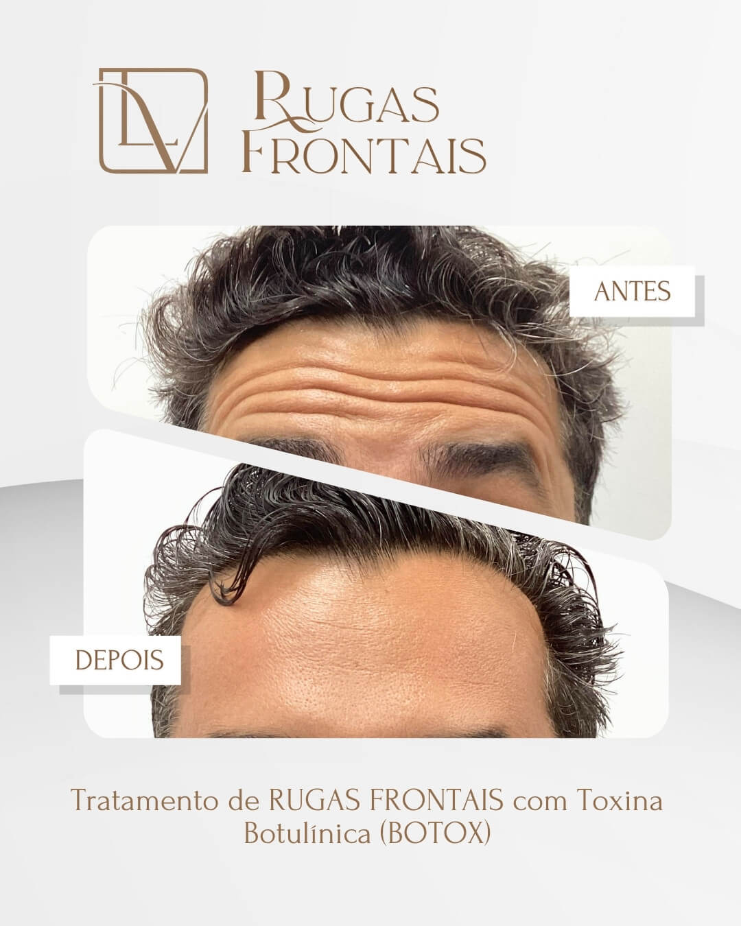 Resultado de tratamento de rugas frontais antes e depois