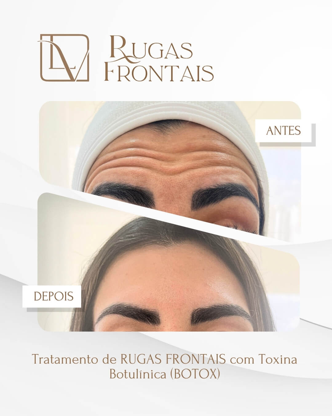 Resultado adicional de suavização de rugas frontais antes e depois