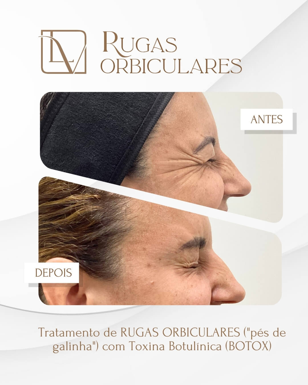 Resultado de tratamento de rugas orbiculares antes e depois
