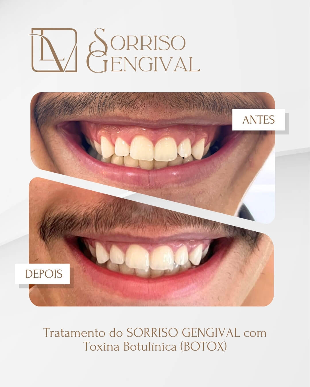 Resultado de tratamento de sorriso gengival antes e depois